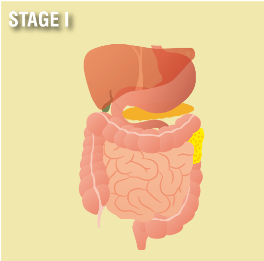 what is stage four mesothelioma most cancers