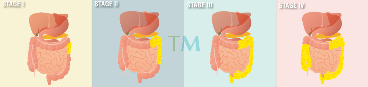 Mesothelioma Stages: Four Stages  Three Staging Systems