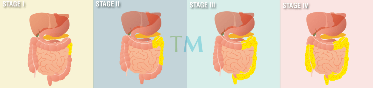 Mesothelioma Stages: Four Stages Three Staging Systems Mesothelioma Stages: Four Stages Three Staging Systems