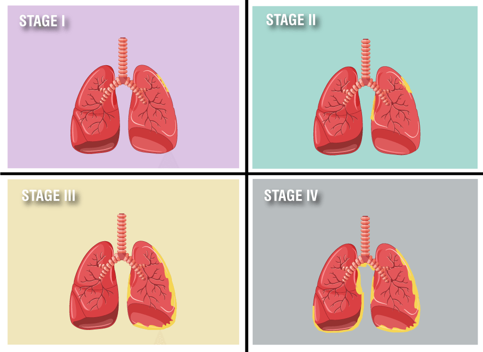 Mesothelioma | Every Topic Covered, Every Patient Informed.