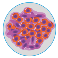 Life Expectancy Mesothelioma Stage 3
