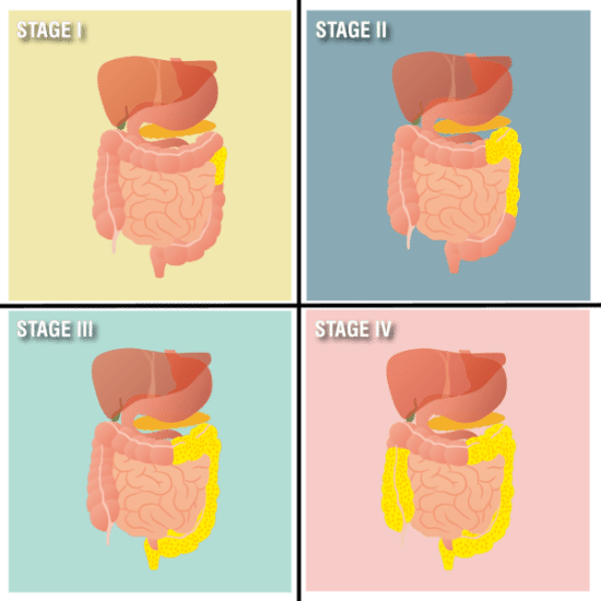 What is Mesothelioma? Mesothelioma Treatment Community What is Mesothelioma? Mesothelioma Treatment Community