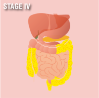 Peritoneal Mesothelioma Stage 4