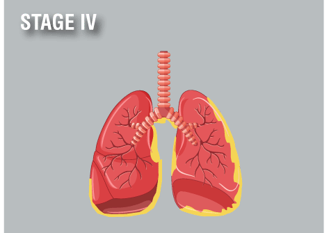 md anderson mesothelioma treatment