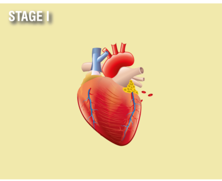 Pericardial Mesothelioma | GET HELP & SURVIVE - Treat Mesothelioma